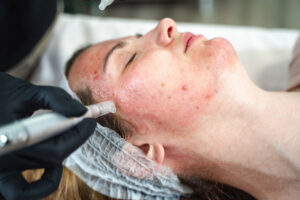 Close up of woman during microneedling skin treatment